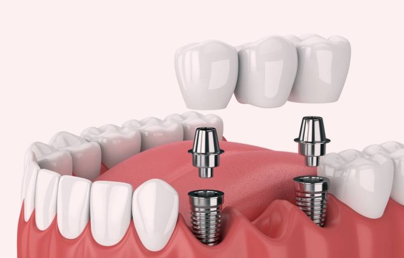 Дентальная имплантация зубов